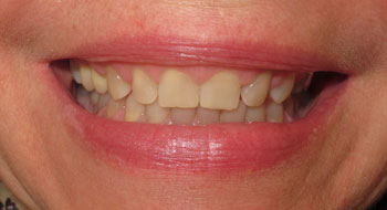 Sourire-après-le-traitement-orthodontique