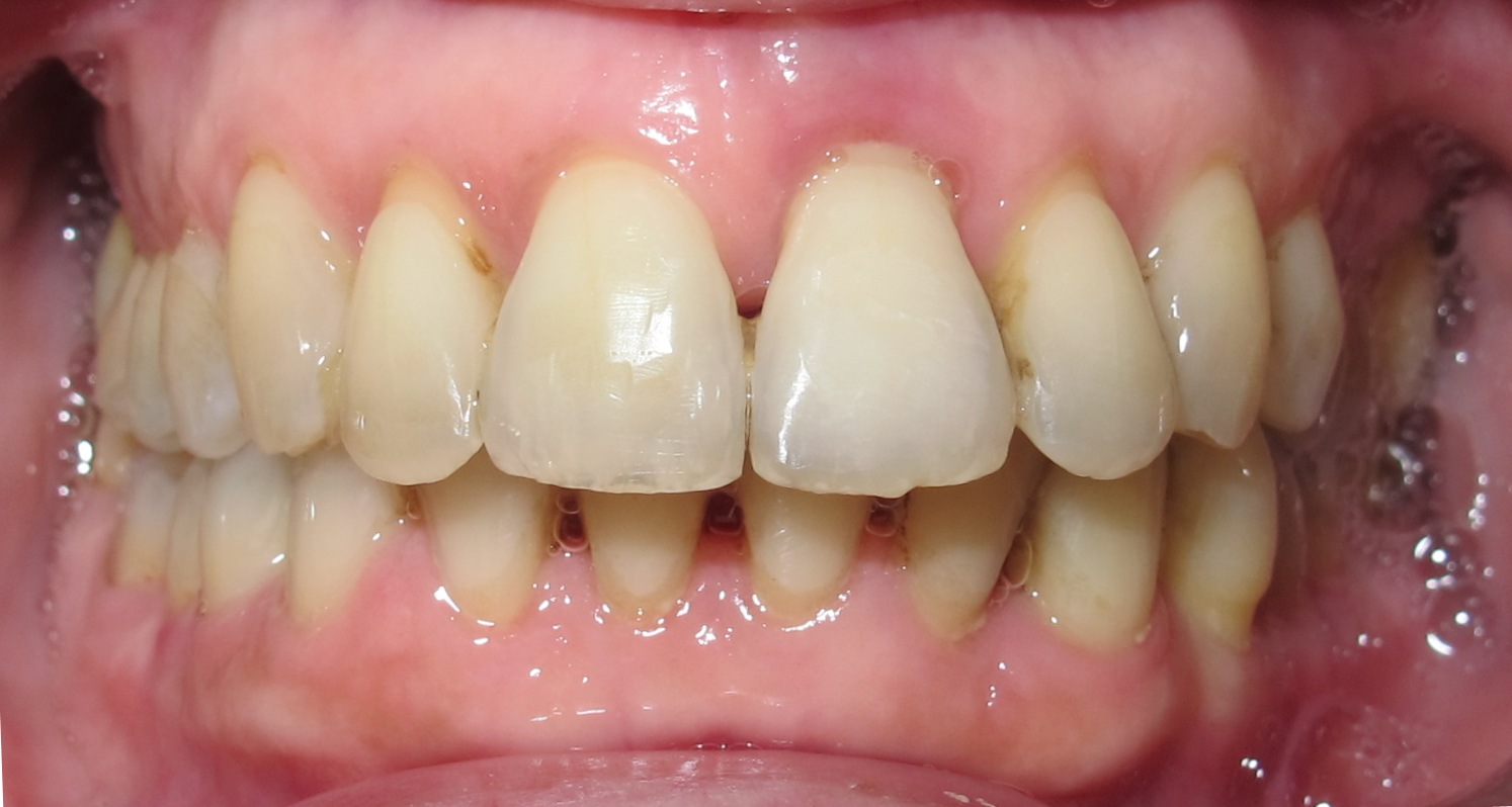 Orthodontie et mobilité dentaire 3