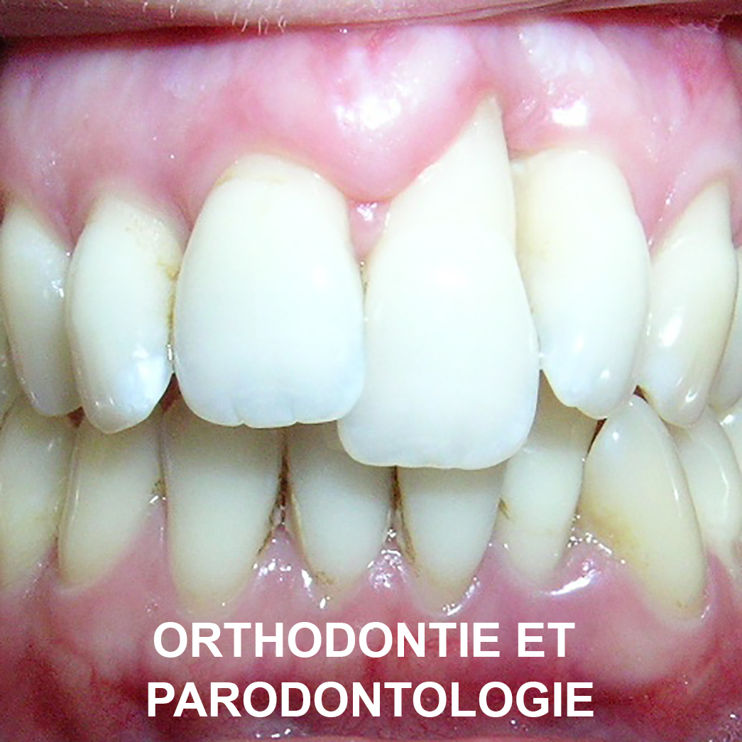 Orthodontie et parodontologie