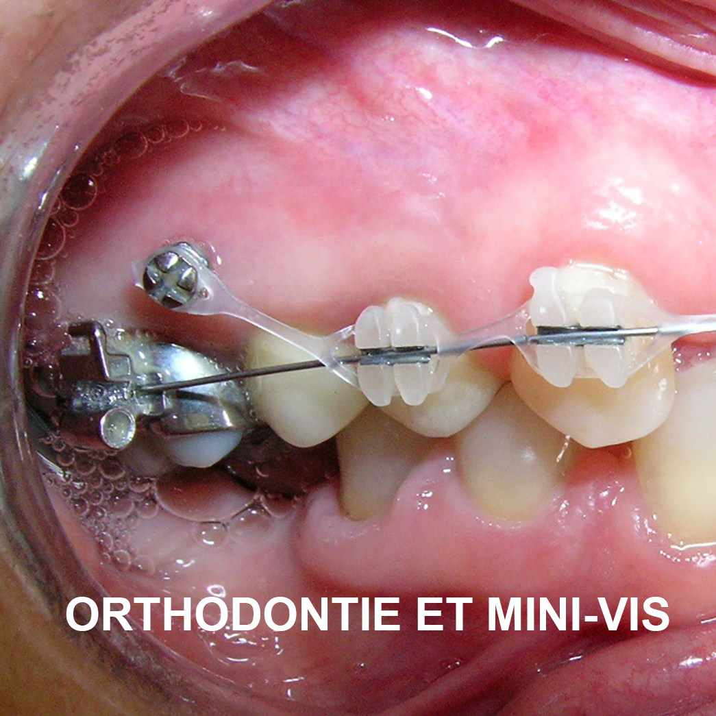 Orthodontie et Mini-vis