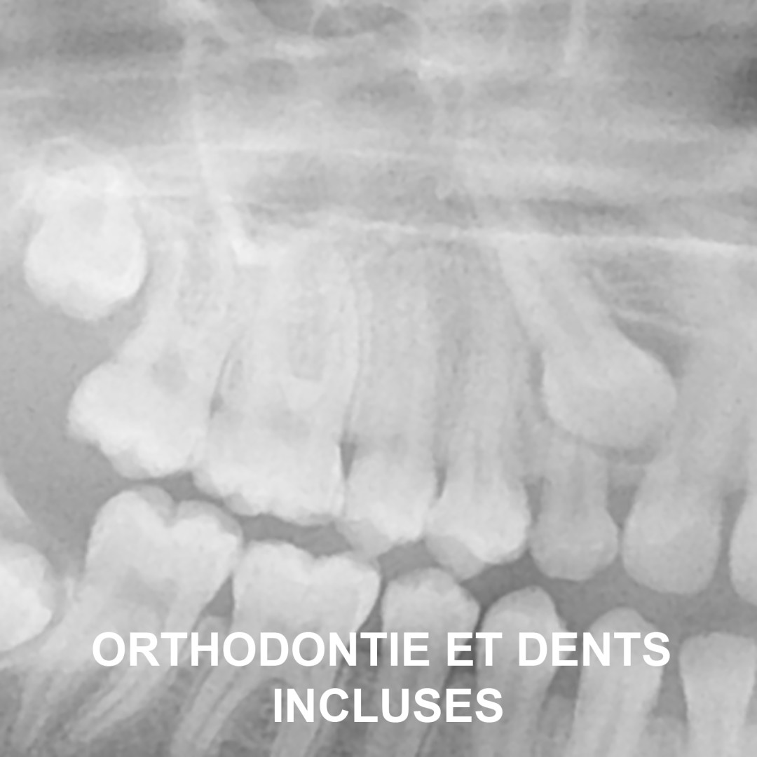 Orthodontie et dents incluses