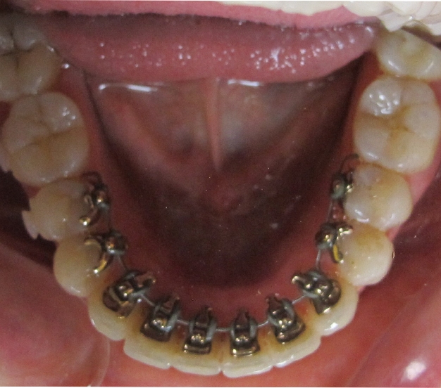 arcade-mandibulaire-en-cours-de-traitement-(orthodontie-linguale)