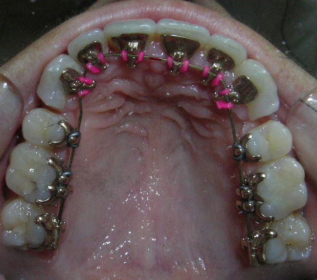 arcade-maxillaire-en-cours-de-traitement-(orthodontie-linguale)