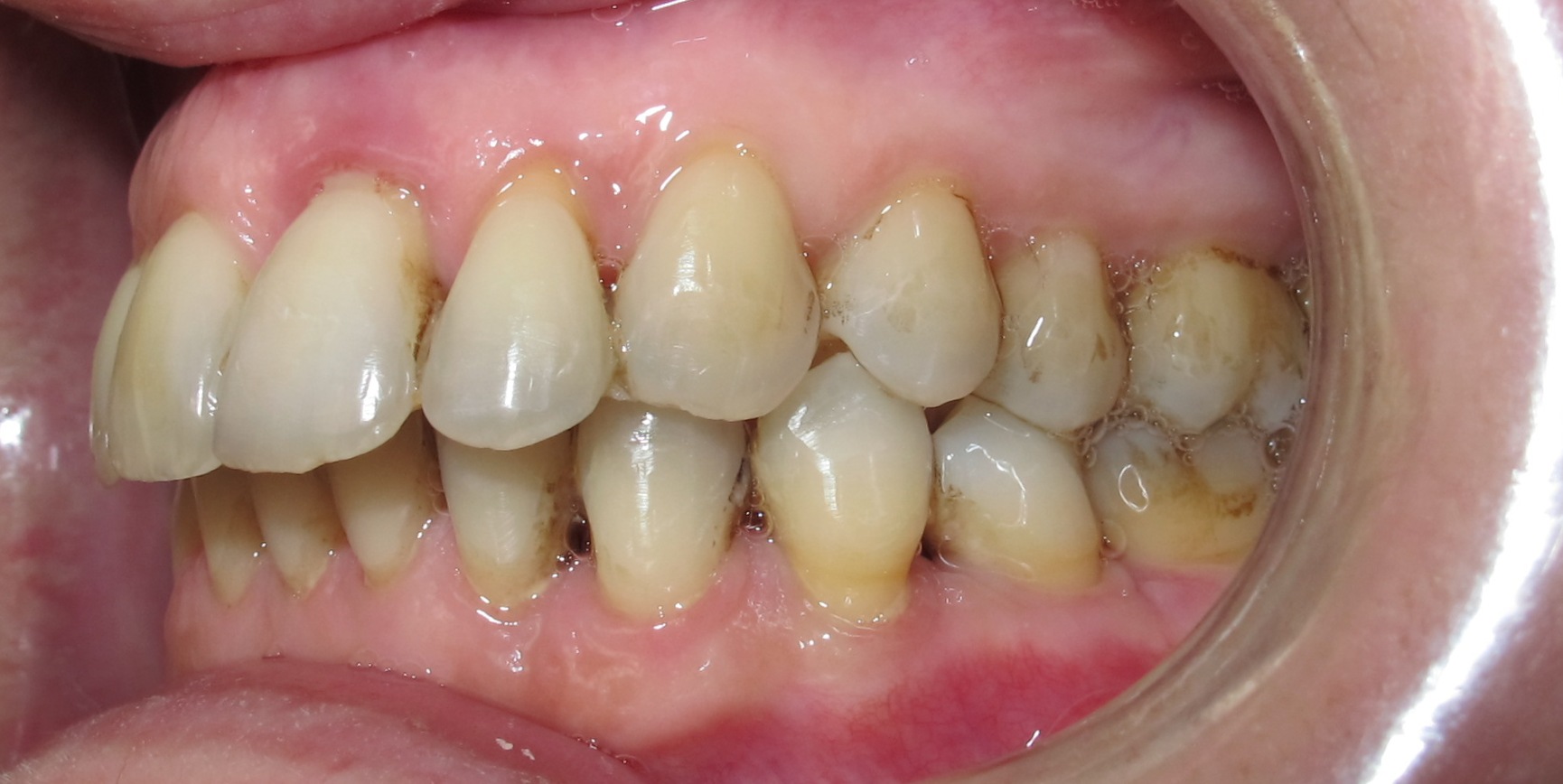 Orthodontie et mobilité dentaire 1