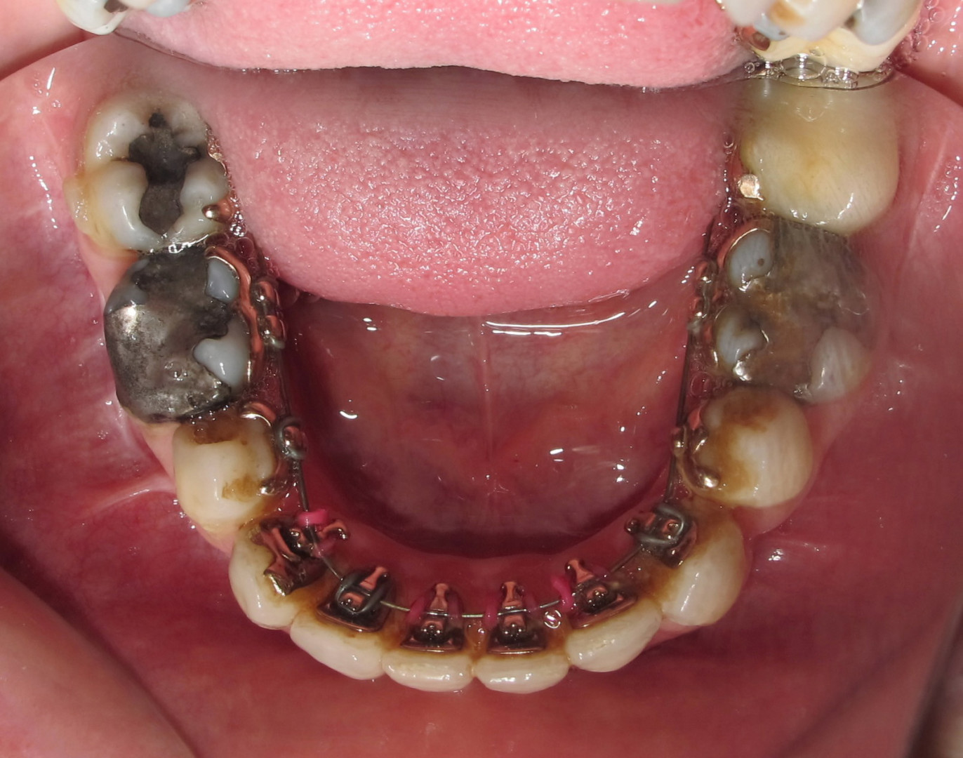 4 - arcade mandibulaire en cours de traitement avec un appareil lingual