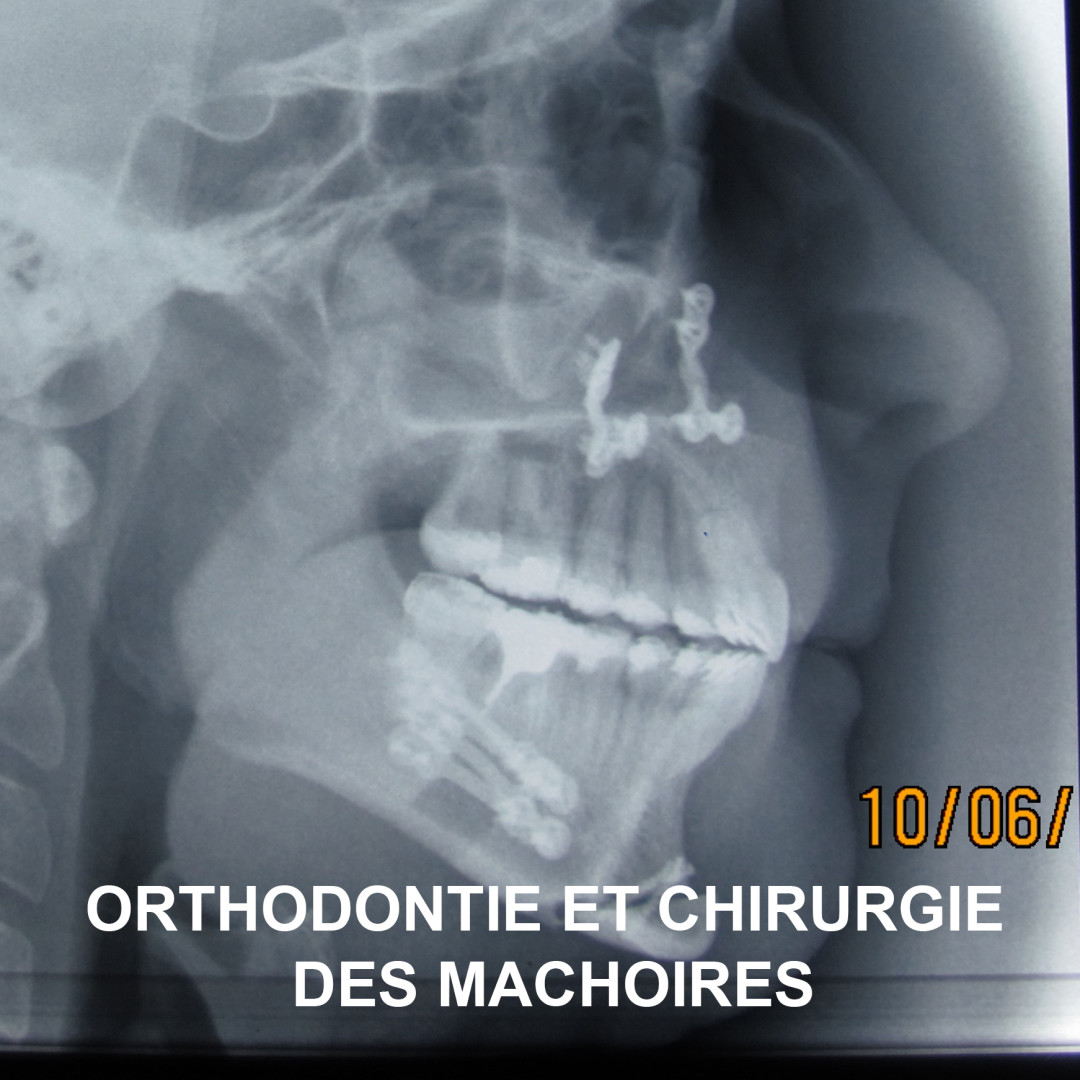 Orthodontie et chirurgie des machoires