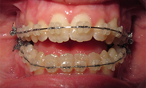 occlusion de face pendant l'alignement dentaire