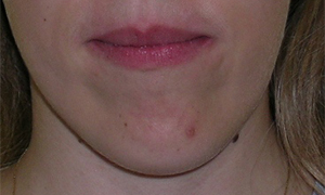 asymétrie de la mandibule avec déviation du menton