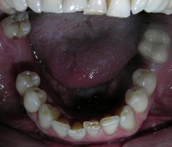 arcade mandibulaire avant traitement1