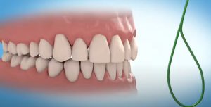 Comment utiliser le fil dentaire avec une contention collée
